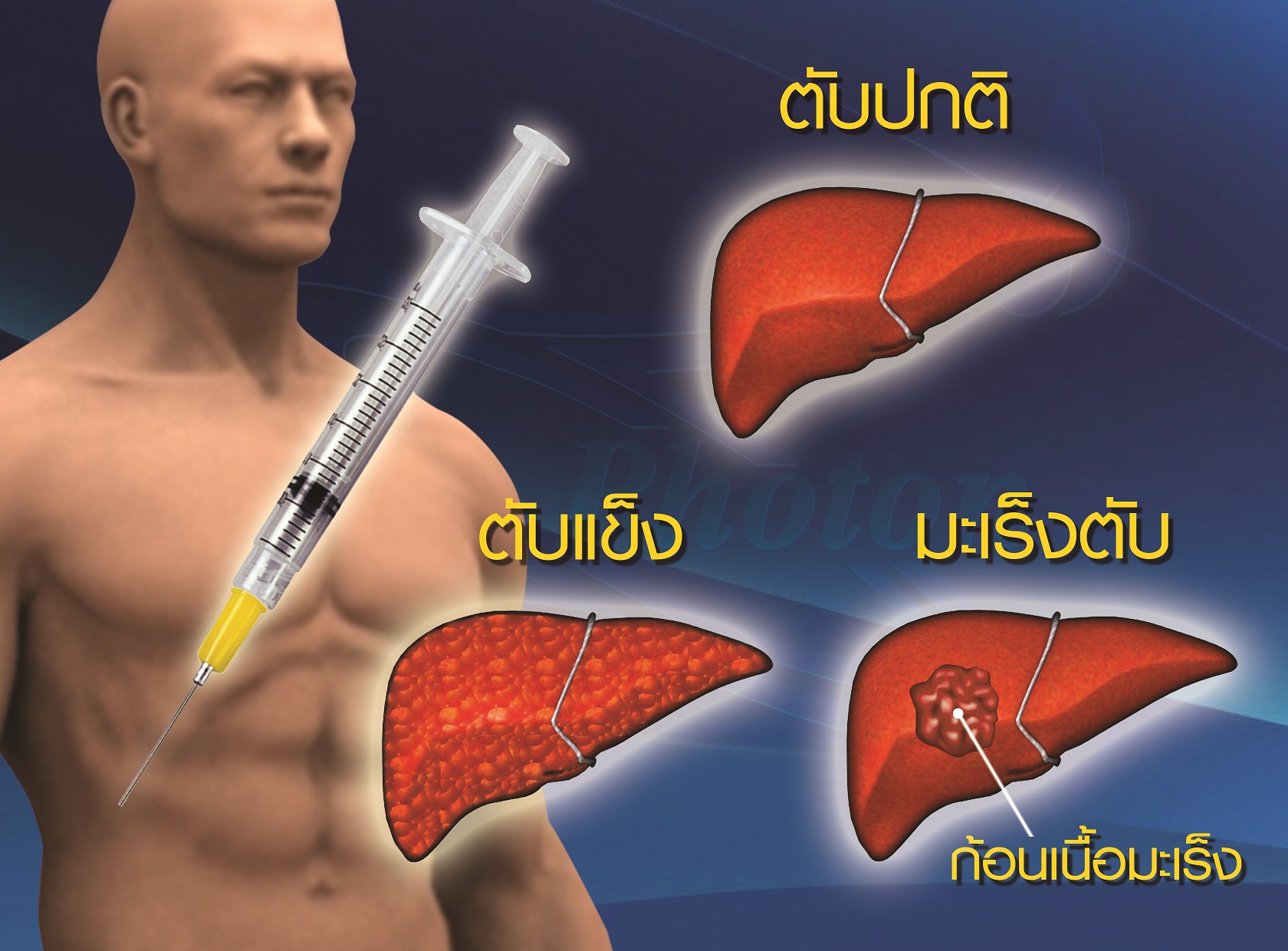 มะเรงตบ 2